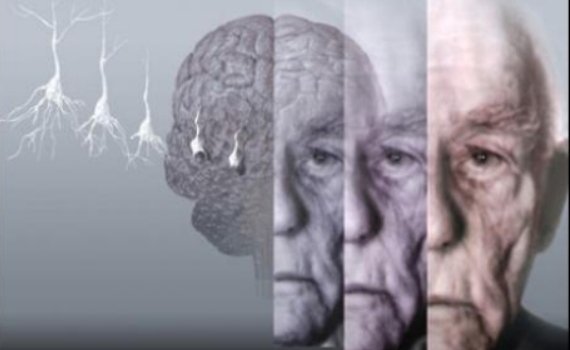 Estudio: El cerebro de los bebés podría ser clave para detectar el Alzheimer